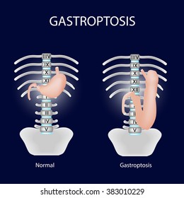 Gastroptosis stomach. The omission of the stomach. Stage gastroptosis. Vector illustration