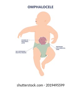 Gastroschisis Omphalocele Usmle Hernia Birth Defect Silo Wall Fetus Fluid Organ Bowel Born Abdomen Baby Care Short Unit Cord Belly Repair Hole Infant Gene Test Fetal Rare Sac Neonate NICU C Section	