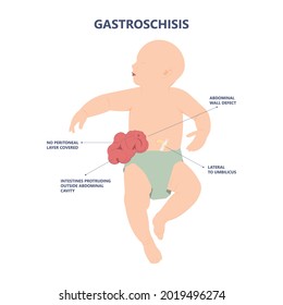 Gastroschisis Omphalocele usmle hernia birth defect silo wall fetus fluid organ bowel born abdomen baby care short unit cord belly repair hole infant gene test fetal rare sac neonate NICU C section	