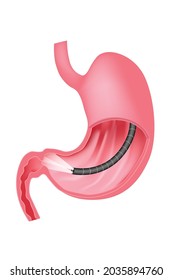 gastroscopy. Endoscopic examination of the stomach. The mucous membrane of the digestive tract. esophagogastroduodenoscopy, fibrogastroduodenoscopy. Vector medical illustration