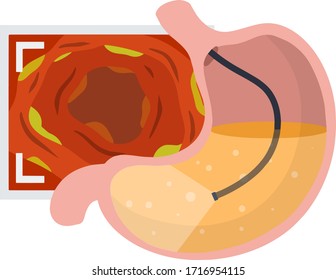Gastroscopy. Endoscopy and digestive problems. Hose with camera. Procedure with internal organs. Cartoon flat illustration. Medical Visual inspection of stomach. Scan of monitor with screen