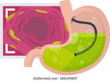 Gastroscopy. Endoscopy and digestive problems. Hose with camera. Procedure with internal organs. Cartoon flat illustration. Medical Visual inspection of stomach. Scan of monitor with screen