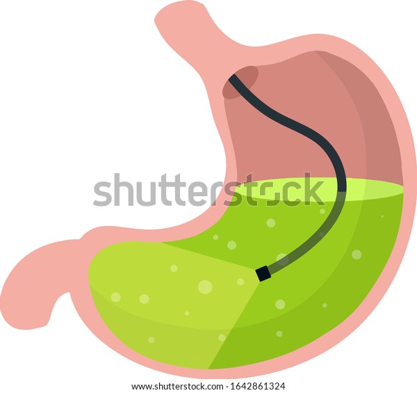 胃鏡検査 胃の視診 内視鏡検査と消化器の問題 カメラとホース 内臓の処置 漫画のフラットイラスト のベクター画像素材 ロイヤリティフリー