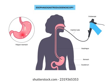 Procedimiento Gastroscopio. Concepto de esofagogastroduodenoscopía. Endoscopia, diagnóstico de estómago en clínica. Gastroenterología, infección gastrointestinal. Enfermedad del tracto digestivo y vector plano de tratamiento