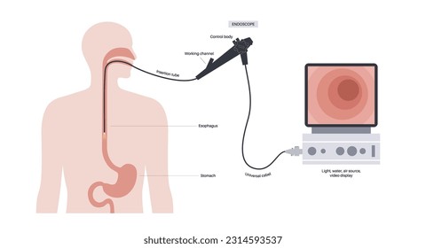 Gastroscopy procedure. Gastroenterologist uses a gastroscope. Endoscopy, stomach diagnostic in clinic. Gastroenterology, gastrointestinal infection. Digestive tract disease and treatment flat vector