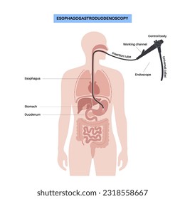 Gastroscopy procedure. Gastroenterologist uses a gastroscope. Stomach, and intestine diagnostic. Gastroenterology, endoscopy and gastrointestinal disease. Digestive system problem and treatment vector