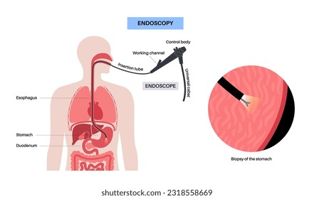 Gastroscopy procedure. Gastroenterologist uses a gastroscope. Stomach, and intestine diagnostic. Gastroenterology, endoscopy and gastrointestinal disease. Digestive system problem and treatment vector