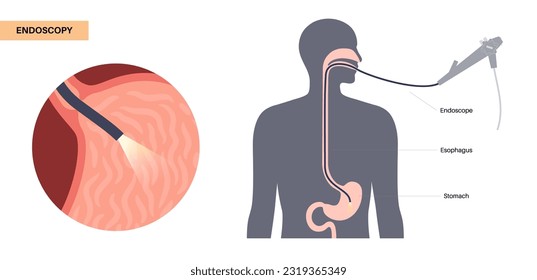 Gastroscopy procedure. Gastroenterologist uses a gastroscope. Endoscopy, stomach diagnostic in clinic. Gastroenterology, gastrointestinal infection. Digestive tract disease and treatment flat vector