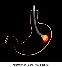 Gastroscopy procedure. Human stomach with Peptic ulcer, and endoscopic device on black background. Illustration for medical use
