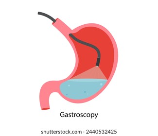 Gastroscopy procedure. Research of a stomach gastroscope. Disease of the stomach and duodenum. Close-up vector image of the stomach. 