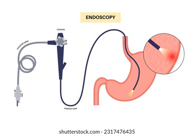 Gastroscopy procedure. Stomach diseases diagnostic. GERD, gastritis, digestive tract inflammation. Gastroenterologist uses a gastroscope, endoscopy concept. Gastroenterology, gastrointestinal problems