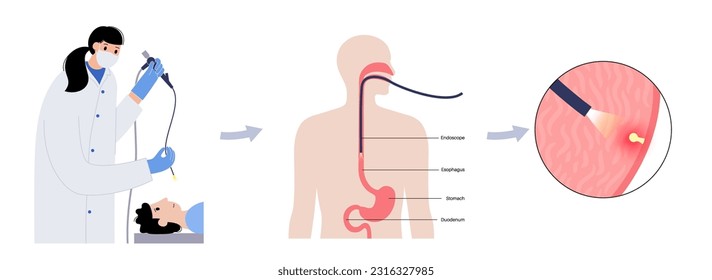 Gastroscopy procedure. Stomach polyps diagnostic. Gastroenterologist uses a gastroscope, endoscopy concept. Gastroenterology, gastrointestinal inflammation. Digestive tract disease and treatment
