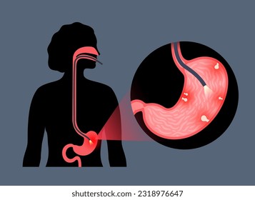 Procedimiento Gastroscopio. Diagnóstico de pólipos de Estómago. El gastroenterólogo utiliza un concepto gastroscopio, endoscopía. Gastroenterología, inflamación gastrointestinal. Enfermedad del tracto digestivo y tratamiento