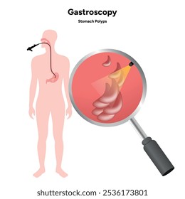 Gastroscopy procedure, stomach polyps in human zoom