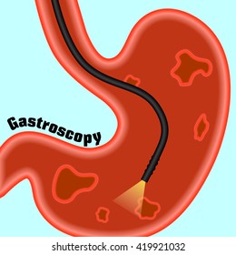 Gastroscopy, research of a stomach gastroscope. Helicobacter pylori. Ulcers. The disease of the stomach and duodenum. ?aricature, cartoon.