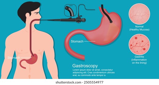 Gastroskopie ist ein Test, um in Ihrem Hals, Speiseröhre (Speiseröhre) und Magen, bekannt als der obere Teil des Verdauungssystems zu überprüfen. medizinische Versorgung, Vektorgrafik.