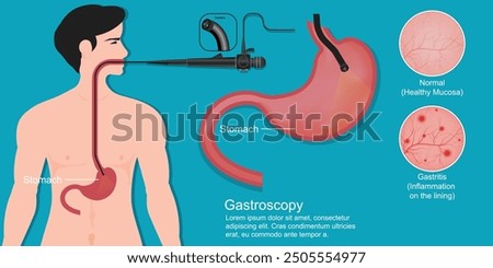Gastroscopy is a test to check inside your throat, food pipe (oesophagus) and stomach, known as the upper part of your digestive system. medical healthcare vector illustration.