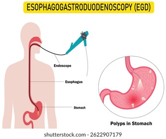 Gastroscopy Vector Diagram – Upper Endoscopy Procedure for Diagnosing Stomach and Duodenum Conditions