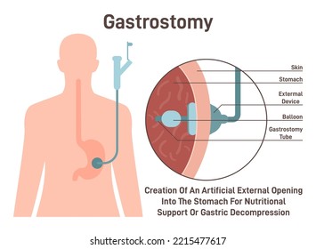 Gastrostomy. Gastric inserted feeding tube, food nutritions injecting. Artificial opening into the stomach or gastric decompression. Flat vector illustration