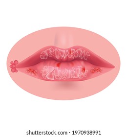 General cheilitis. Inflammation of the lips. Cracked mucous membrane. Vector illustration