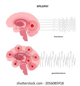 Generalized Partial Seizure Epilepsy Abnormal Brain Stock Vector ...