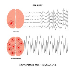 Generalized and partial seizure. Epilepsy and abnormal brain activity. Pain, spasm, migraine, headache or stress in human head. CNS disorder. Mental health clinic. Medical research vector illustration