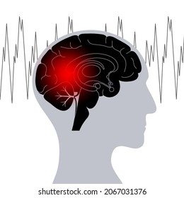 Generalized or partial seizure. Epilepsy and abnormal brain activity. Pain, spasm, migraine, headache or stress in human head. CNS disorder. Mental health clinic. Medical research vector illustration.