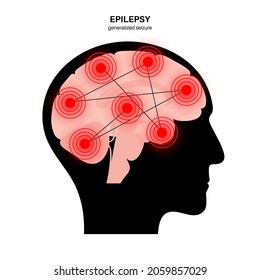 Generalized seizure. Epilepsy disease concept. Abnormal brain activity. Pain or spasm in human head. Central nervous system disorder. Mental health clinic. Medical research flat vector illustration.