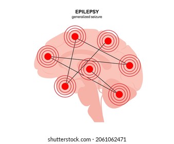 Generalized seizure. Epilepsy disease concept. Abnormal brain activity. Pain or spasm in human head. Central nervous system disorder. Mental health clinic. Medical research flat vector illustration.