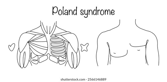 A genetic abnormality in which parts of the muscles, tissues and subcutaneous fatty tissue of the breast are missing on one side. Drawing anatomy of Poland syndrome. Medical vector.