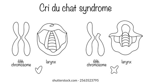 A genetic disease manifested by changes in voice in children due to the absence of a fragment of the fifth chromosome and underdevelopment of the larynx. Cri du chat syndrome.