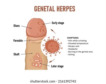 Genital  Herpes. Herpes Simplex Virus