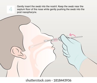 Gently insert the swab into the nostril. Keep the swab near the septum floor of the nose while gently pushing the swab into the post nasopharynx