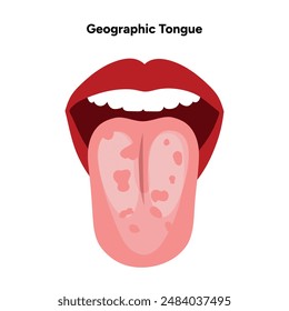 Geographic tongue in human mouth