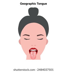 Geographic tongue problem in human