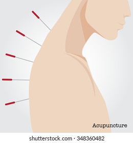 Getting acupuncture treatment. Vector illustration.