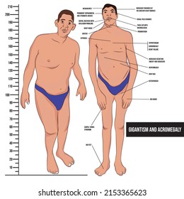 Gigantism and acromegaly are syndromes characterized by excessive secretion of growth hormone.