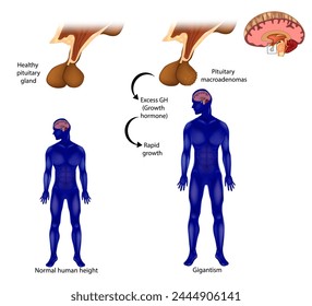 Gigantism  also known as giantism. Adenoma, a tumor of the pituitary gland. Excess GH