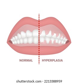 Gingival hyperplasia. Medical poster. Vector illustration