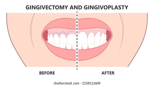 Gingivectomy gum graft smile small teeth deep cleaning prep flap dental attached gingiva alveolar bone laser tooth Care lift tissue treat clean plaque bacteria Tartar calculus