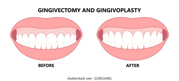 Gingivectomy gum graft smile small teeth deep cleaning prep flap dental attached gingiva alveolar bone laser tooth Care lift tissue treat clean plaque bacteria Tartar calculus