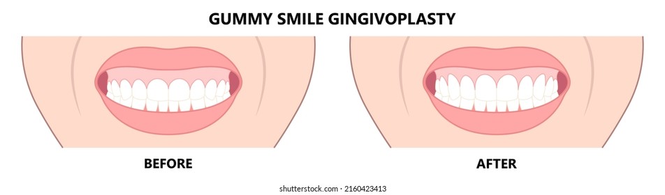 Gingivectomy gum graft smile small teeth deep cleaning prep flap dental attached gingiva alveolar bone laser tooth Care lift tissue treat clean plaque bacteria Tartar calculus