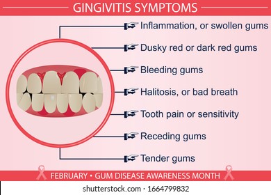 Vektor Stok Gingivitis Disease Risk Factors Infographic Vector (Tanpa ...