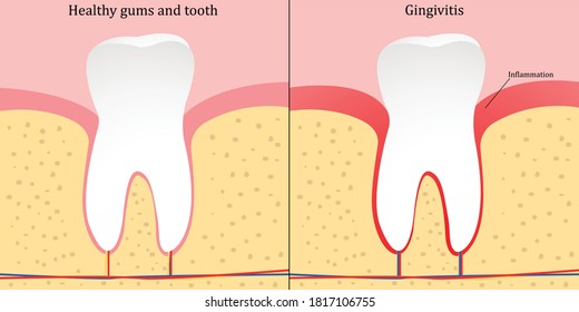 Gingivitis - gum disease. Vector illustration