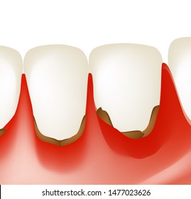 Gingivitis. Inflammation of the gums. Dental calculus. Infographics. Vector illustration on isolated background