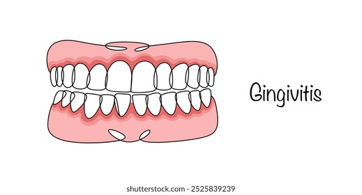 Gingivitis. Inflamación de las encías, que es causada por bacterias en la cavidad oral. Una simple Ilustración vectorial de color sobre un tema médico. Vector aislado sobre fondo blanco.