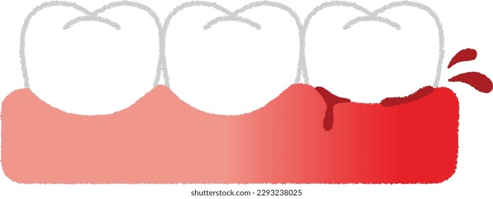 Gingivitis is a mild periodontal disease in which the gums become inflamed. The gums become red, swollen, and bleeding easily.