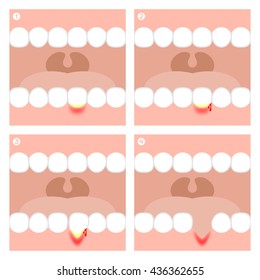Gingivitis or Periodontitis illustration vector infographic