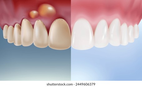 Gingivitis or swollen gums is caused by unclean teeth, inflammation from germs and plaque. Comparative concept of oral dentistry. Vector realistic illustration.