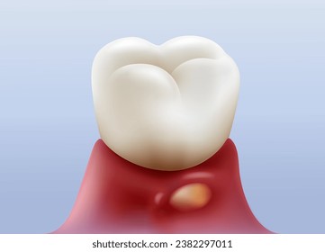 Gingivitis, hinchazón y purulencia o inflamación de las raíces dentales Para clínicas y tratamientos dentales. Archivo de ilustración vectorial realista.